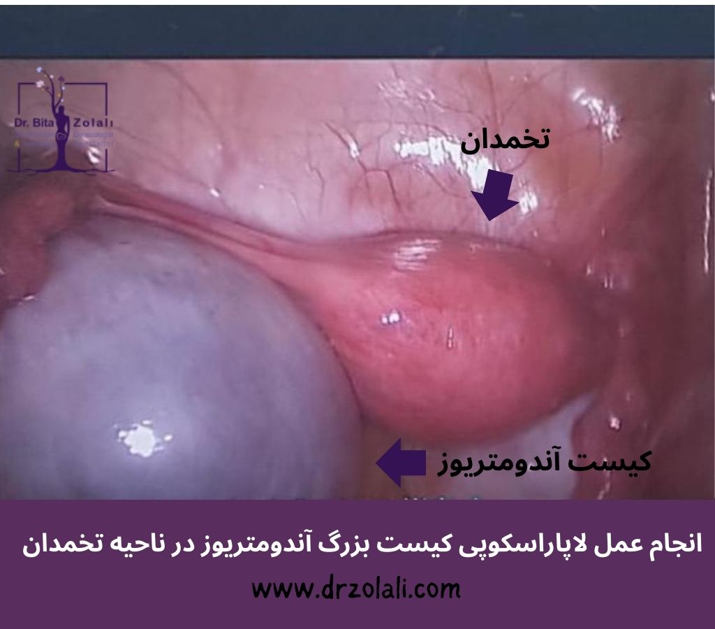 لاپاراسکوپی آندومتریوز تخمدان – دکتر بیتا زلالی لاپاراسکوپی آندومتریوز تخمدان - دکتر بیتا زلالی