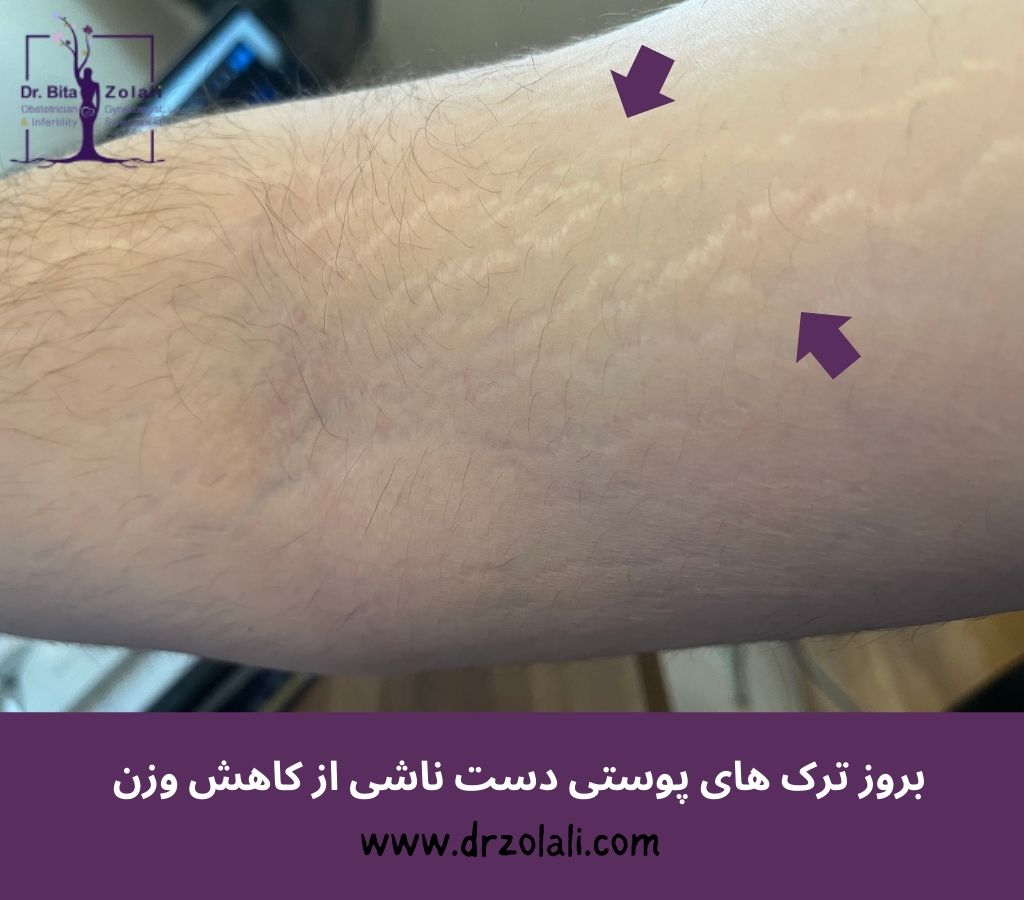 لیزر ترک های پوستی ناشی از کاهش یا افزایش وزن - دکتر بیتا زلالی