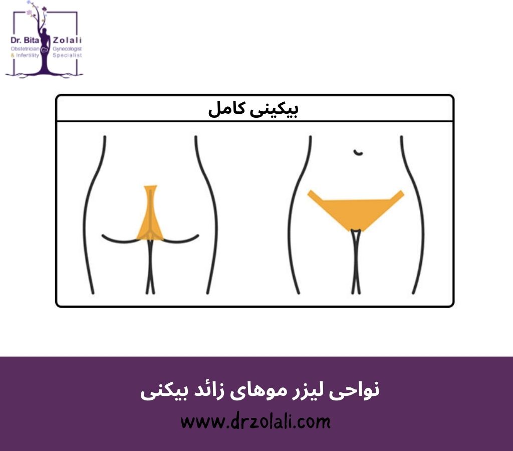نواحی لیزر موی زائد بیکنی – دکتر بیتا زلالی نواحی لیزر موی زائد بیکنی - دکتر بیتا زلالی