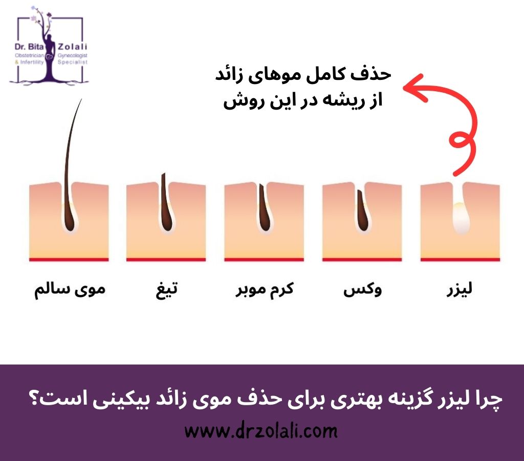 چرا باید موهای زائد بیکینی خود را لیزر کنیم؟ – دکتر بیتا زلالی چرا باید موهای زائد بیکینی خود را لیزر کنیم؟ - دکتر بیتا زلالی