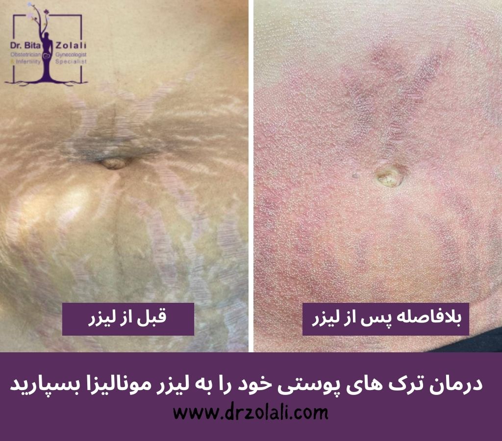 عکس قبل و بعد درمان ترک های پوستی با لیزر - دکتر بیتا زلالی