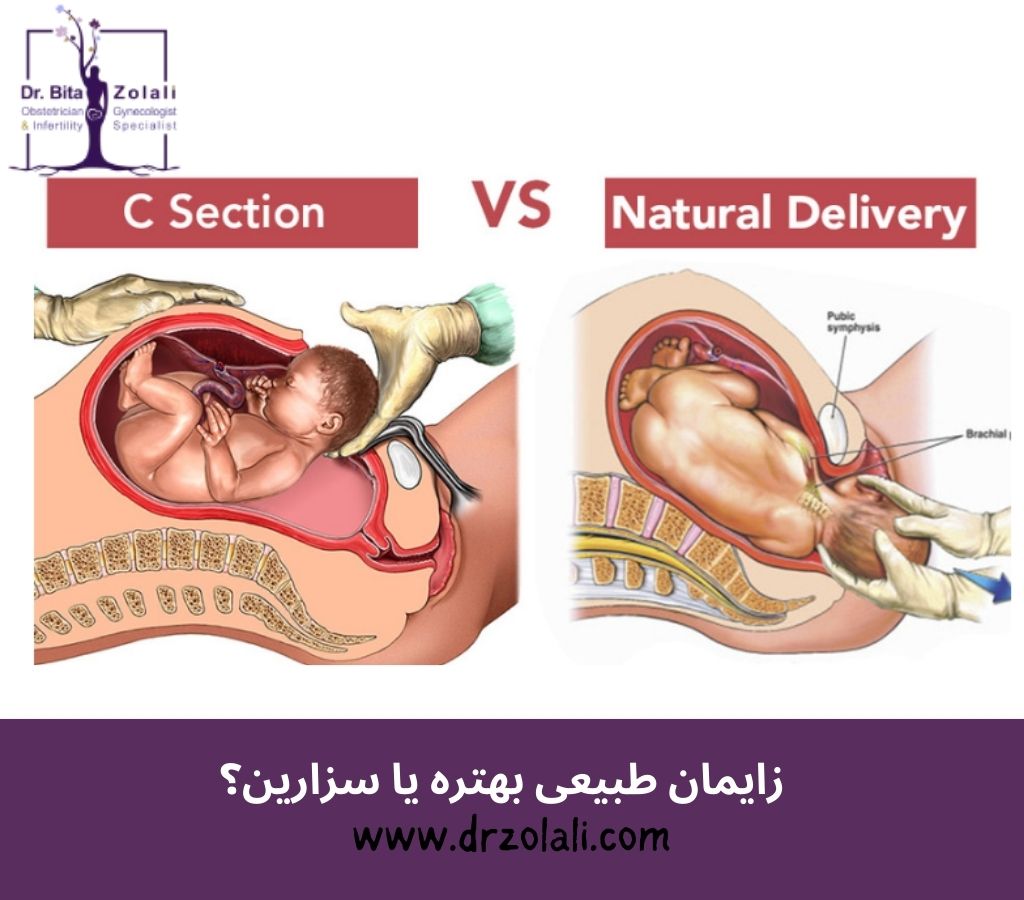 زایمان طبیعی بهتره یا سزارین؟ – دکتر بیتا زلالی زایمان طبیعی بهتره یا سزارین؟ - دکتر بیتا زلالی